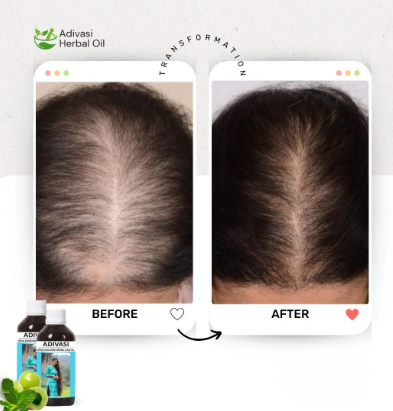 ORIGINAL ADIVASI HERBAL HAIR OIL - BUY 1 GET 1 FREE (⭐️⭐️⭐️⭐️⭐️ 4.9/5)